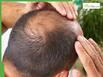Baldness in Men: How To Regrow Hair From Zero In 7 Simple Ways
