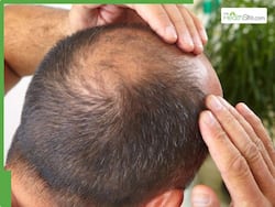 Baldness in Men: How To Regrow Hair From Zero In 7 Simple Ways