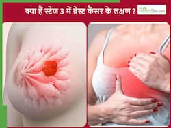 ब्रेस्ट कैंसर के 3 स्टेज में क्या होता है? जानिए इस स्टेज में दिखाई देने वाले लक्षण