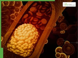 Top 5 Cholesterol Myths, Here's What American Heart Association Says