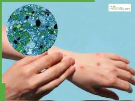 First U.S. Case Of Serious Mpox Strain Without Travel History Raises Concerns Of Local Spread First U.S. Case Of Serious Mpox Strain Without Travel History Raises Concerns Of Local Spread