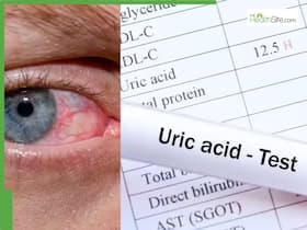 High Uric Acid Symptoms: 5 Warning Signs In Your Eyes That Says Your Uric Acid Levels Is Too High