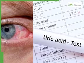 High Uric Acid Symptoms: 5 Warning Signs In Your Eyes That Says Your Uric Acid Levels Is Too High