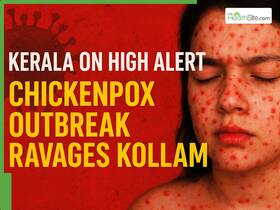 Kerala On High Alert:  Chickenpox Outbreak Ravages Kollam, Expert Urge Everyone To Get Vaccinated - Who Is At High Risk?