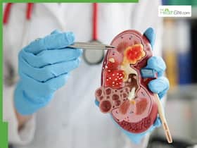 Kidney Diet: 6 Powerful Foods To Support Better Function And Filtration Kidney Diet: 6 Powerful Foods To Support Better Function And Filtration