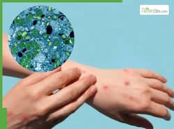 Mpox Clade Ib Spreads In Europe: Travel And Health Tips To Protect Yourself From Highly Contagious Virus