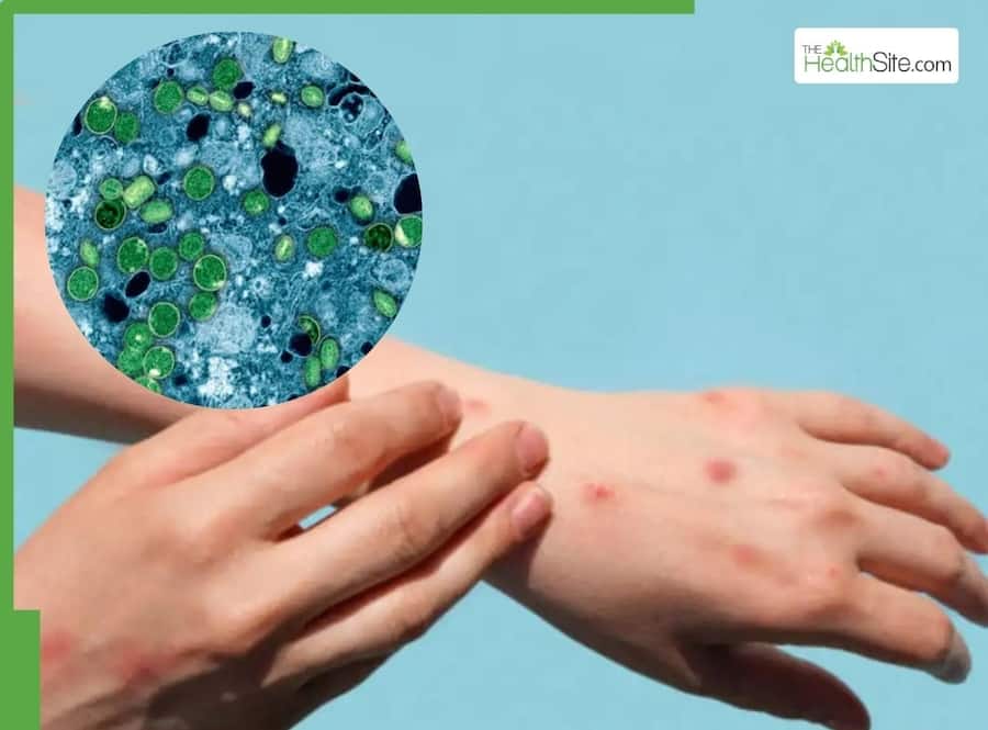 Mpox Clade Ib Spreads In Europe: Travel And Health Tips To Protect Yourself From Highly Contagious Virus