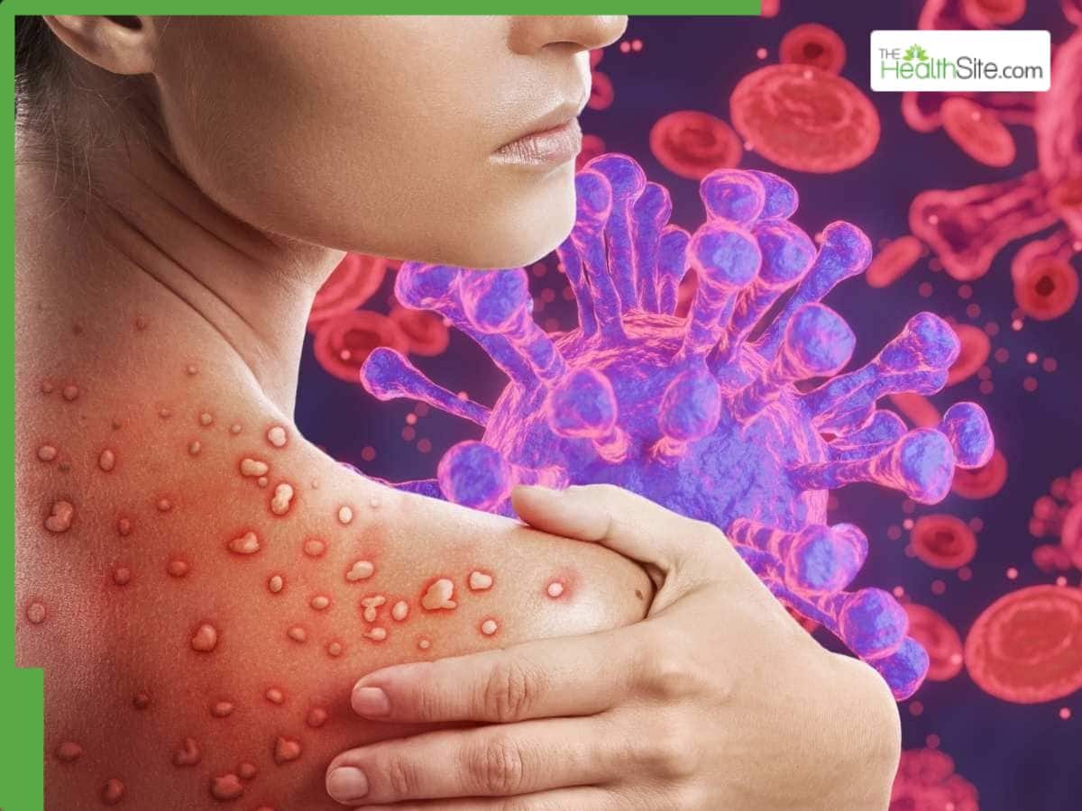 Spain Mpox Alert: First Human Case Of Mpox Clade 1B Confirmed, Symptoms And Prevention Tips