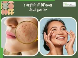 1 महीने में पिंपल्स कैसे हटाएं? जानें 5 तरीके, जिनसे चेहरा दिखेगा साफ