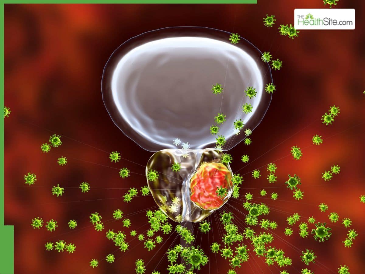 World Cancer Day 2026: Stages Of Prostate Cancer Every Patient Must Know For Swift Medical Intervention