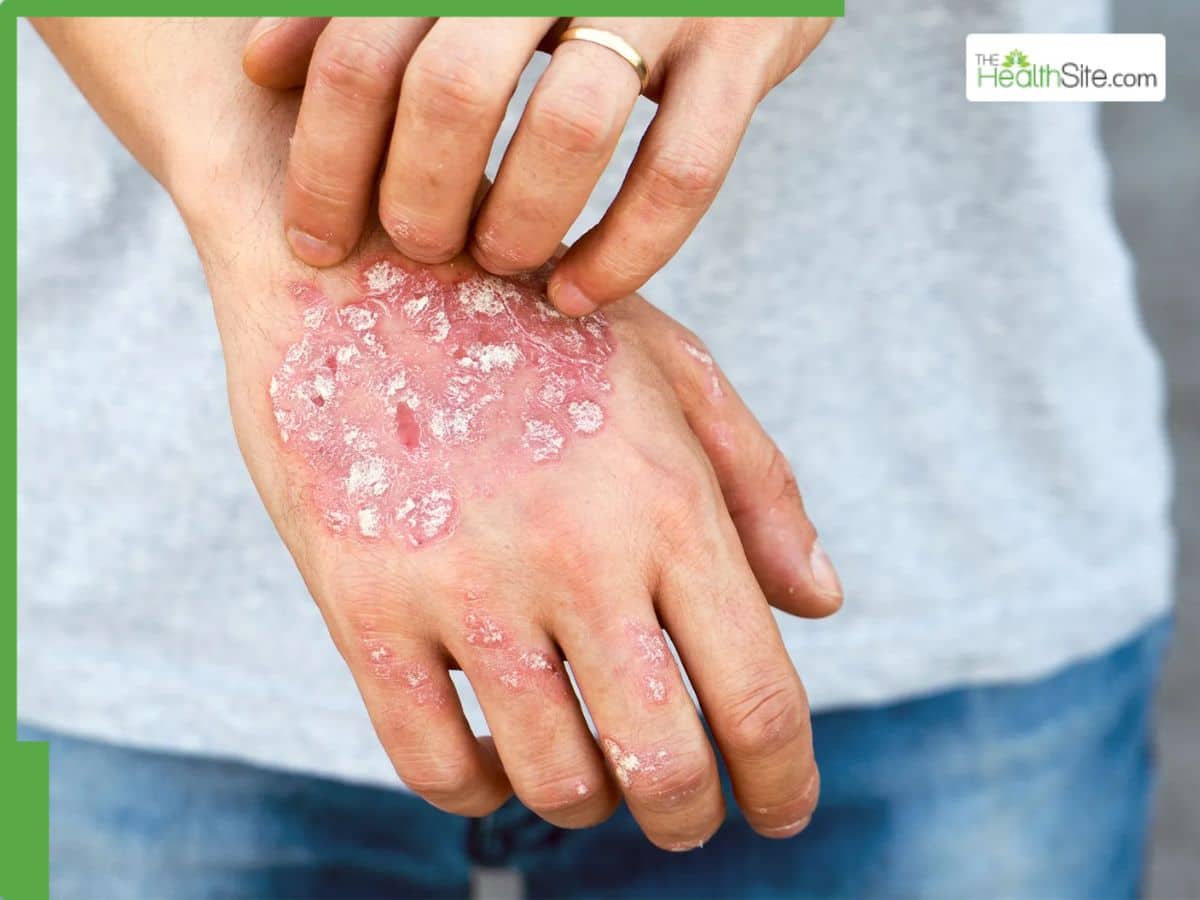 World Psoriasis Day 2025: Can Stress Really Trigger Psoriasis? Here’s All You Need To Know