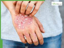World Psoriasis Day 2025: Can Stress Really Trigger Psoriasis? Here's All You Need To Know