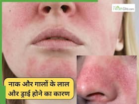 गालों के आसपास की रेडनेस और पपड़ी कैसे ठीक करें? जानें 3 तरीके जो स्किन को बना देंगे ग्लोइंग और फ्लॉलेस