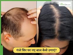 गंजे सिर पर बाल उगाने का सबसे अच्छा तरीका क्या है? जानें 5 घरेलू नुस्खे जो हैं बड़े असरदार