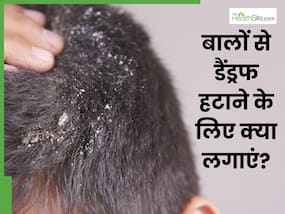 बालों से डैंड्रफ हटाने के लिए क्या लगाएं? जानें 5 तरीके, जिनसे मिट जाएगी खुजली भी