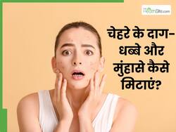 चेहरे के दाग-धब्बे और मुंहासे मिटाने के लिए क्या लगाएं? जानें 5 घरेलू उपाय