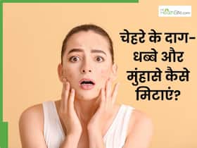 चेहरे के दाग-धब्बे और मुंहासे मिटाने के लिए क्या लगाएं? जानें 5 घरेलू उपाय