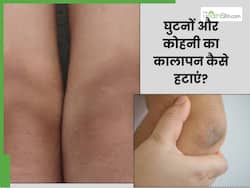 कोहनी और घुटनों के कालेपन से परेशान हैं तो लगाएं ये 5 चीजें, साफ हो जाएगी स्किन
