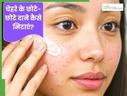 चेहरे पर छोटे-छोटे दाने हो जाए तो क्या करें? जानें 3 घरेलू उपाय, जिनसे मिट जाएगी समस्या