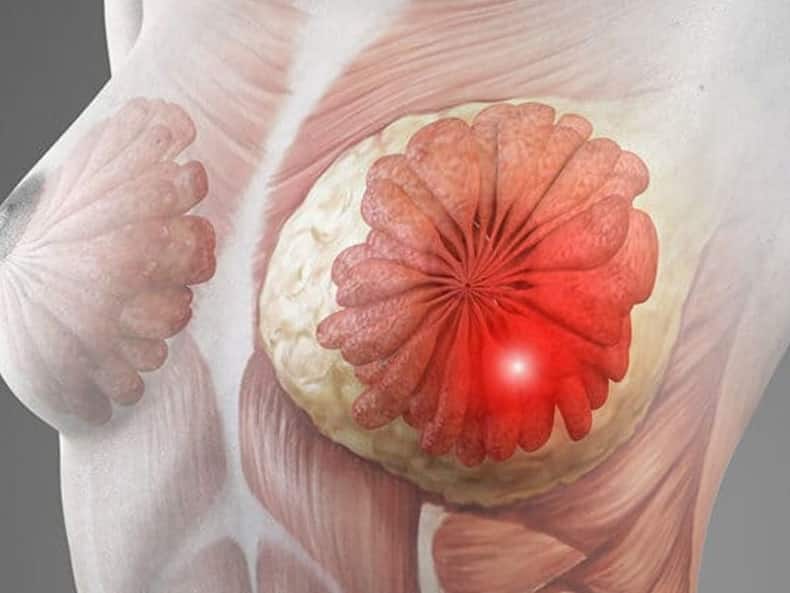 क्या पैड्स और टैम्पोन की वजह से Breast Cancer होता है?