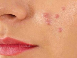 इन 5 गलतियों के कारण ठीक नहीं हो पाते हैं चेहरे के पिंपल्स और एक्ने, बता रहे हैं एक्सपर्ट