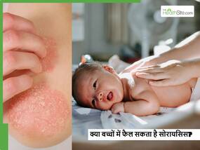 World Psoriasis day: क्या मरीज द्वारा छोटे बच्चों को छूने से फैल सकता है सोरायसिस? जानें क्या कहते हैं एक्सपर्ट्स World Psoriasis day: क्या मरीज द्वारा छोटे बच्चों को छूने से फैल सकता है सोरायसिस? जानें क्या कहते हैं एक्सपर्ट्स