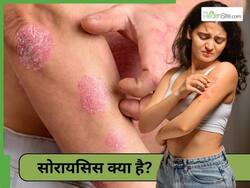 सोरायसिस सिर्फ त्वचा को प्रभावित नहीं करता है, जानें इस बीमारी से शारीरिक और मानसिक स्वास्थ्य पर क्या असर पड़ता है