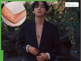BTS Member V Once Suffered From cholinergic urticaria : What This Infection Actually Means BTS Member V Once Suffered From cholinergic urticaria : What This Infection Actually Means