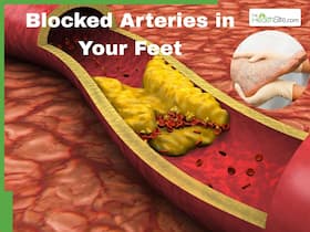 Blocked Arteries in Your Feet: 7 Warning Signs You Should Never Ignore