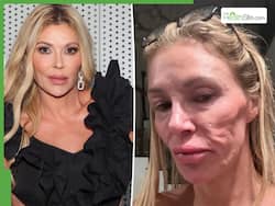 Brandi Glanville Reveals New Recovery Update Following Her Severe Facial Disfigurement Battle