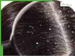 Scalp Serums Vs Oils: Which Is Better To Tackle Dandruff, Flaking And Itching