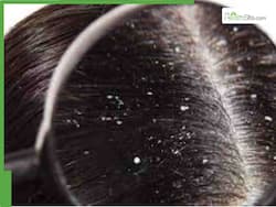 Scalp Serums Vs Oils: Which Is Better To Tackle Dandruff, Flaking And Itching