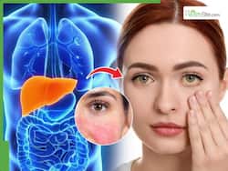 Fatty Liver Symptoms On Face: 5 Early Facial Changes You Should Not Ignore