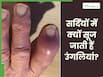 सर्दियों में क्यों सूजने लगती हैं उंगलियां? जानिए इसके कारण और बचाव के उपाय