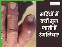 सर्दियों में क्यों सूजने लगती हैं उंगलियां? जानिए इसके कारण और बचाव के उपाय
