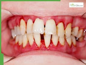 Have Bleeding Gums and Pus? Dentists Warn It Could Be a Sign of Periodontitis