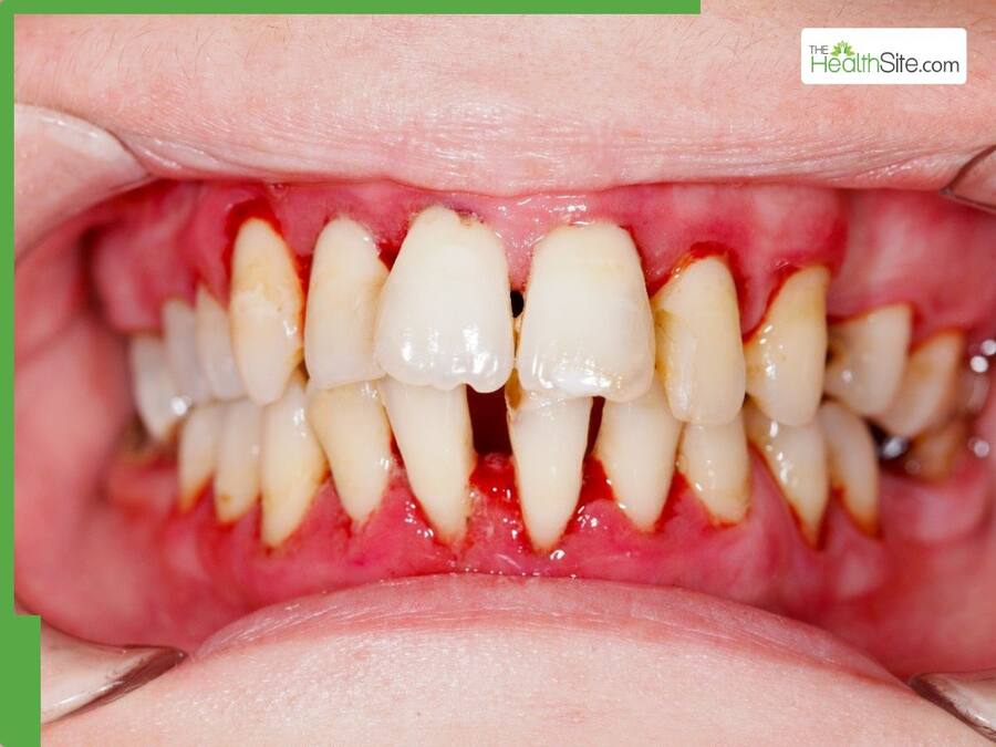 Have Bleeding Gums and Pus? Dentists Warn It Could Be a Sign of ...