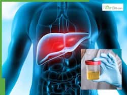 Liver Damage Signs In Your Urine: 7 Early Warning Symptoms You Should Never Ignore