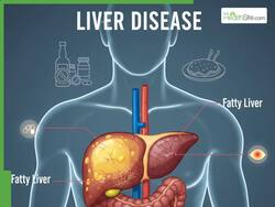 Liver Disease: People With THIS Blood Type Are At Higher Risk, Warns Study