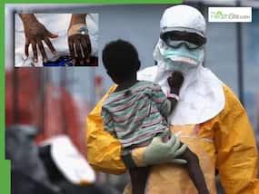 World Health News LIVE Updates: New Mpox Variant Wrecking Havoc In UK, To Deadly Measles Sweeping Through London - Today's News Highlight World Health News LIVE Updates: New Mpox Variant Wrecking Havoc In UK, To Deadly Measles Sweeping Through London - Today's News Highlight