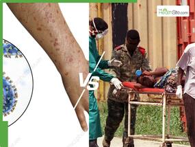 Marburg vs Ebola: What Makes This Virus Even More Deadly and Dangerous?