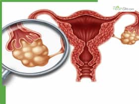 PCOS And Stress: How Hormonal Imbalances Affects Your Mood? PCOS And Stress: How Hormonal Imbalances Affects Your Mood?