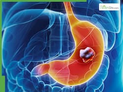 Stomach Cancer Symptoms: 5 Warning Signs That Are Hard To Spot At First