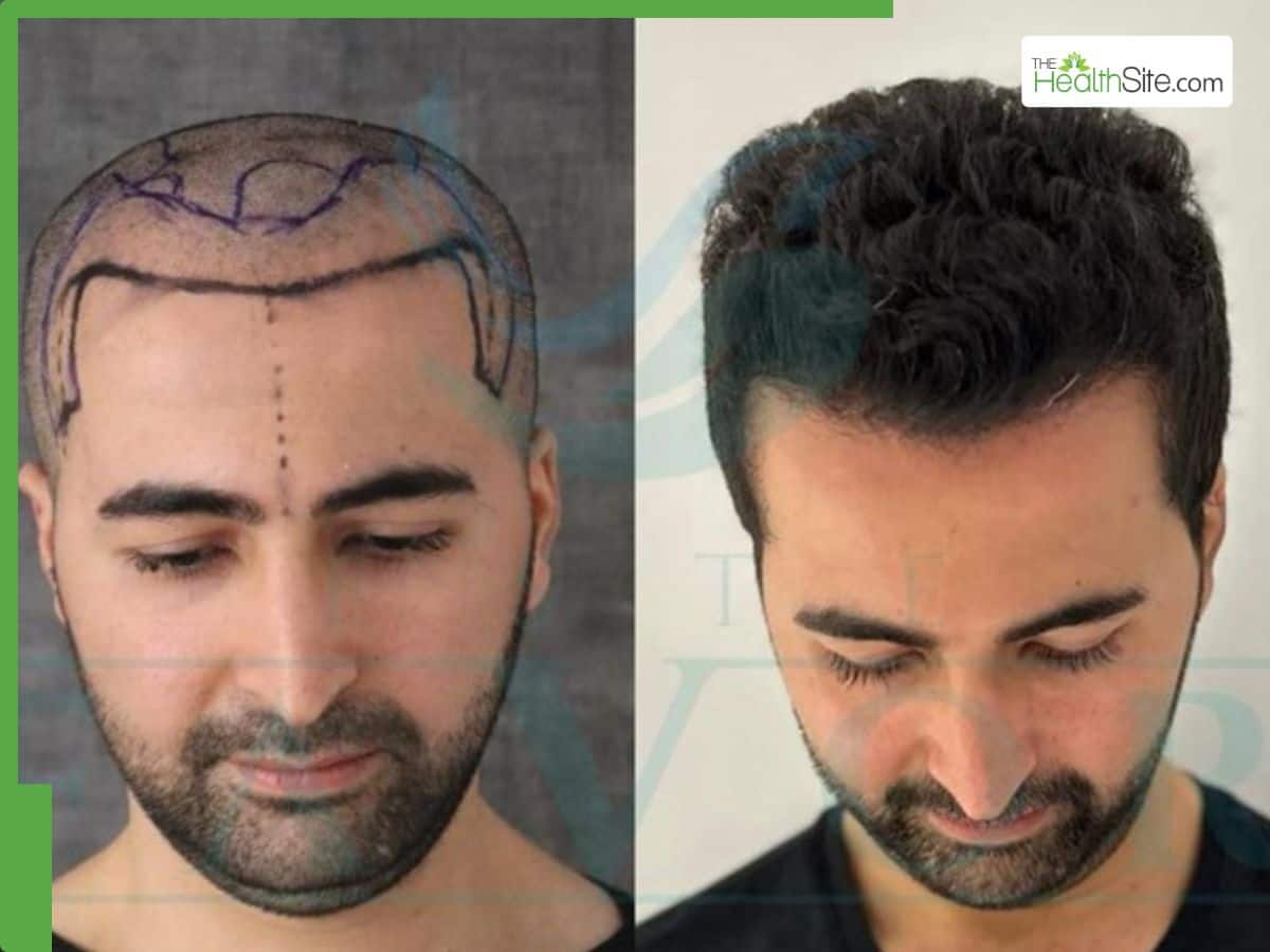 Top 5 Best Hair Transplant Clinics In Turkey: 2025 Complete Guide |  T