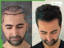 Top 5 Best Hair Transplant Clinics In Turkey: 2025 Complete Guide