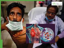 Tuberculosis Cases Drop By 21% In India, Double The Global Decline: WHO Report