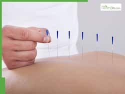 World Acupuncture Day: Health Benefits of Acupuncture Backed By Science