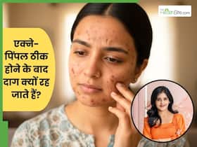 एक्ने-पिंपल ठीक होने के बाद दाग क्यों रह जाते हैं? डॉक्टर से जानें कारण और ठीक करने का तरीका