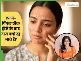 एक्ने-पिंपल ठीक होने के बाद दाग क्यों रह जाते हैं? डॉक्टर से जानें कारण और ठीक करने का तरीका एक्ने-पिंपल ठीक होने के बाद दाग क्यों रह जाते हैं? डॉक्टर से जानें कारण और ठीक करने का तरीका