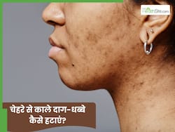 चेहरे से काले धब्बे कैसे साफ करें? जानें 5 तरीके, जो देंगे कमाल का निखार